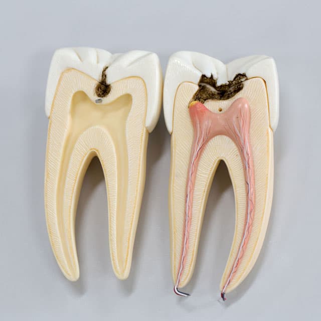 Tratamiento de endodoncia en Ordes y Santiago