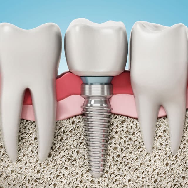 Tratamiento de implante dental en Ordes y Santiago