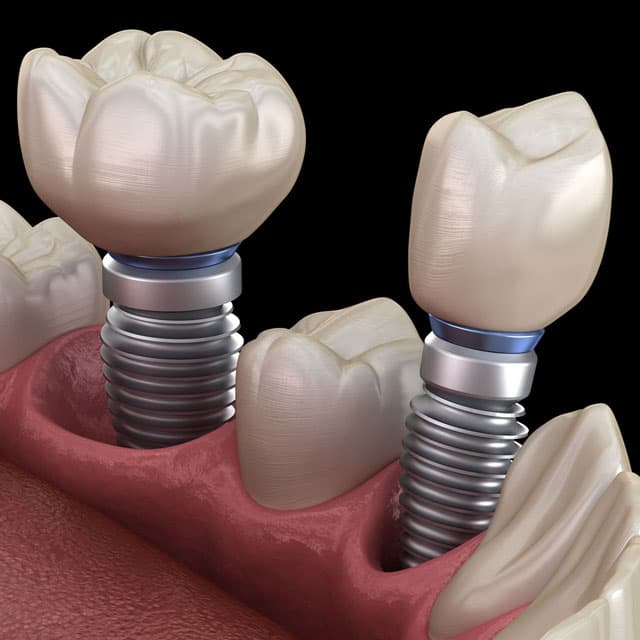 Expertos en implantología dental