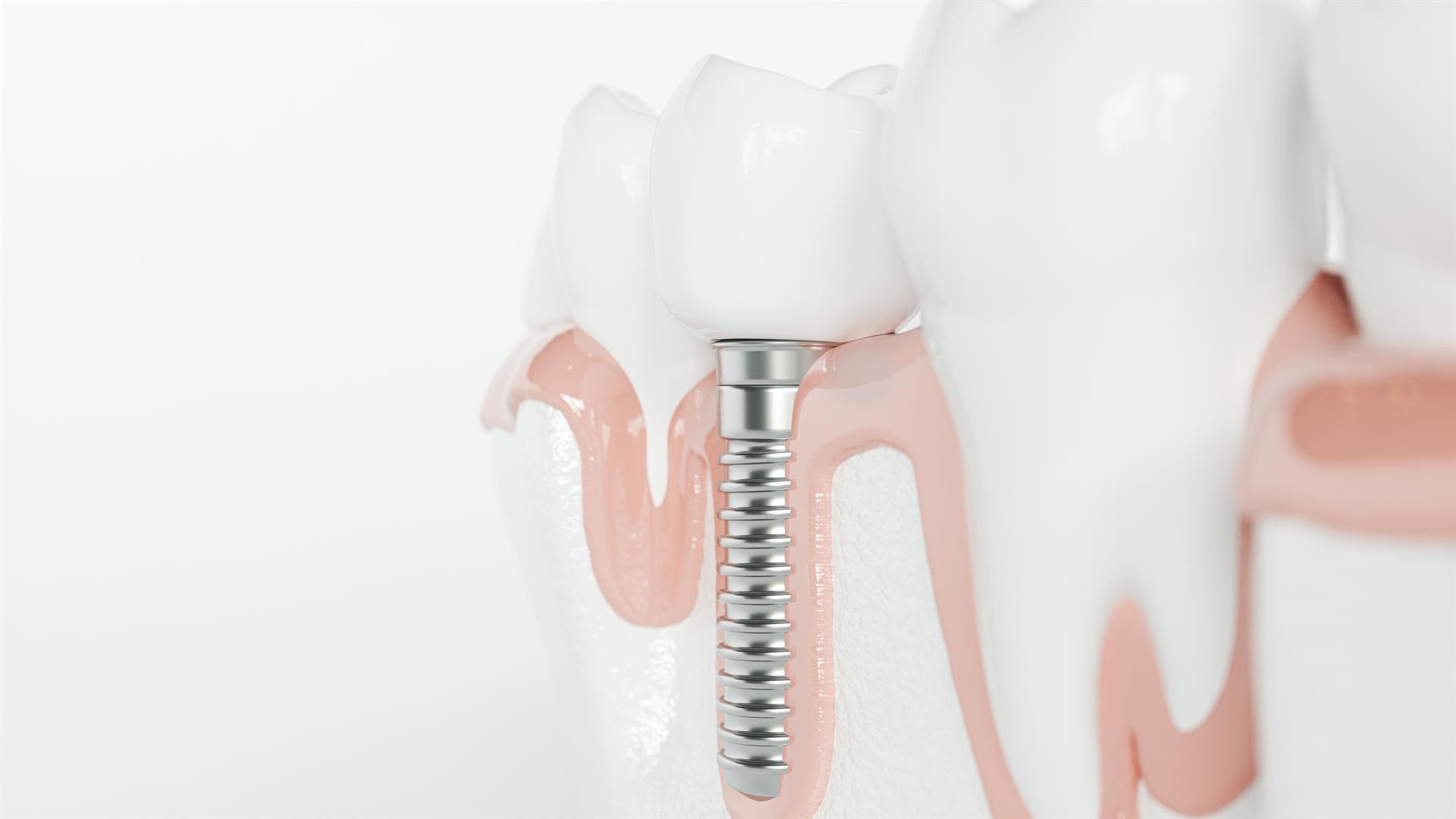 Tratamientos de implante dental en Ordes y Santiago